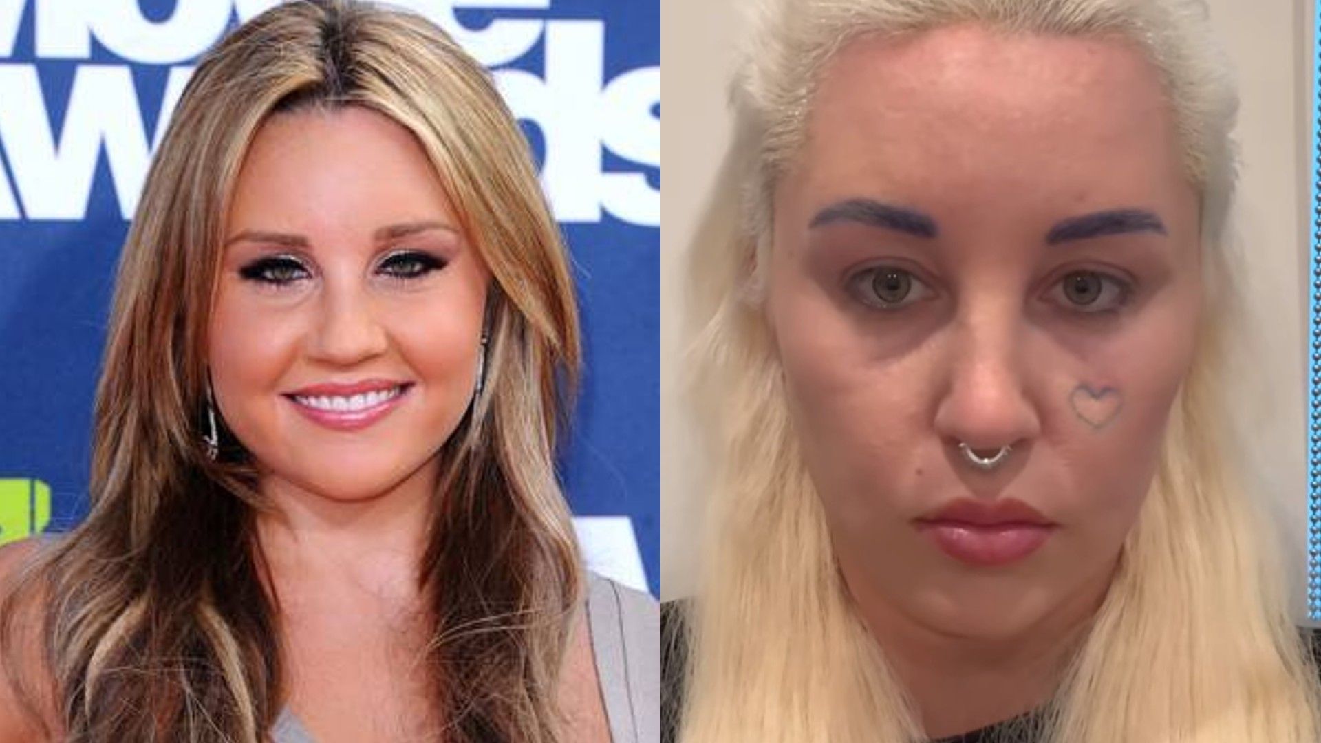 Amanda Bynes înainte și după blefaroplastie